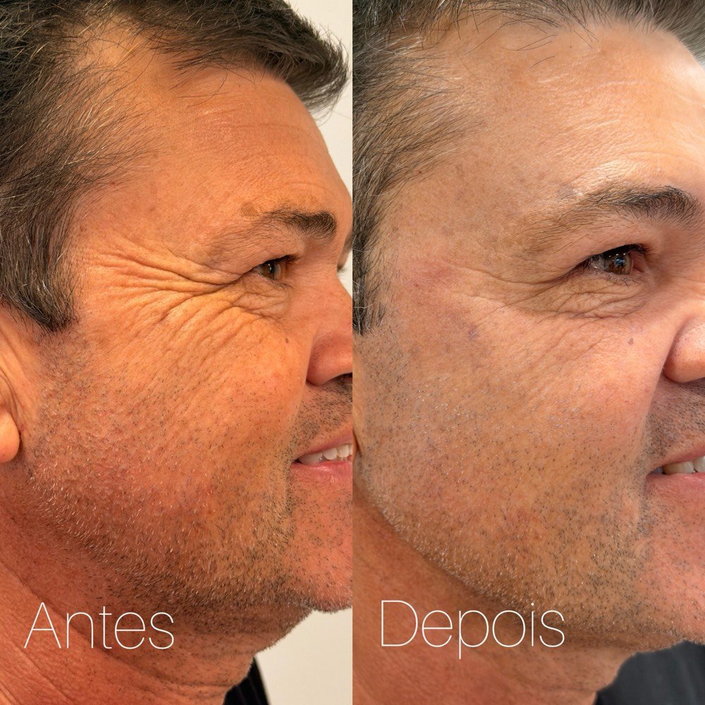 Antes e depois de tratamento das linhas de expressão ao redor dos olhos, em paciente masculino