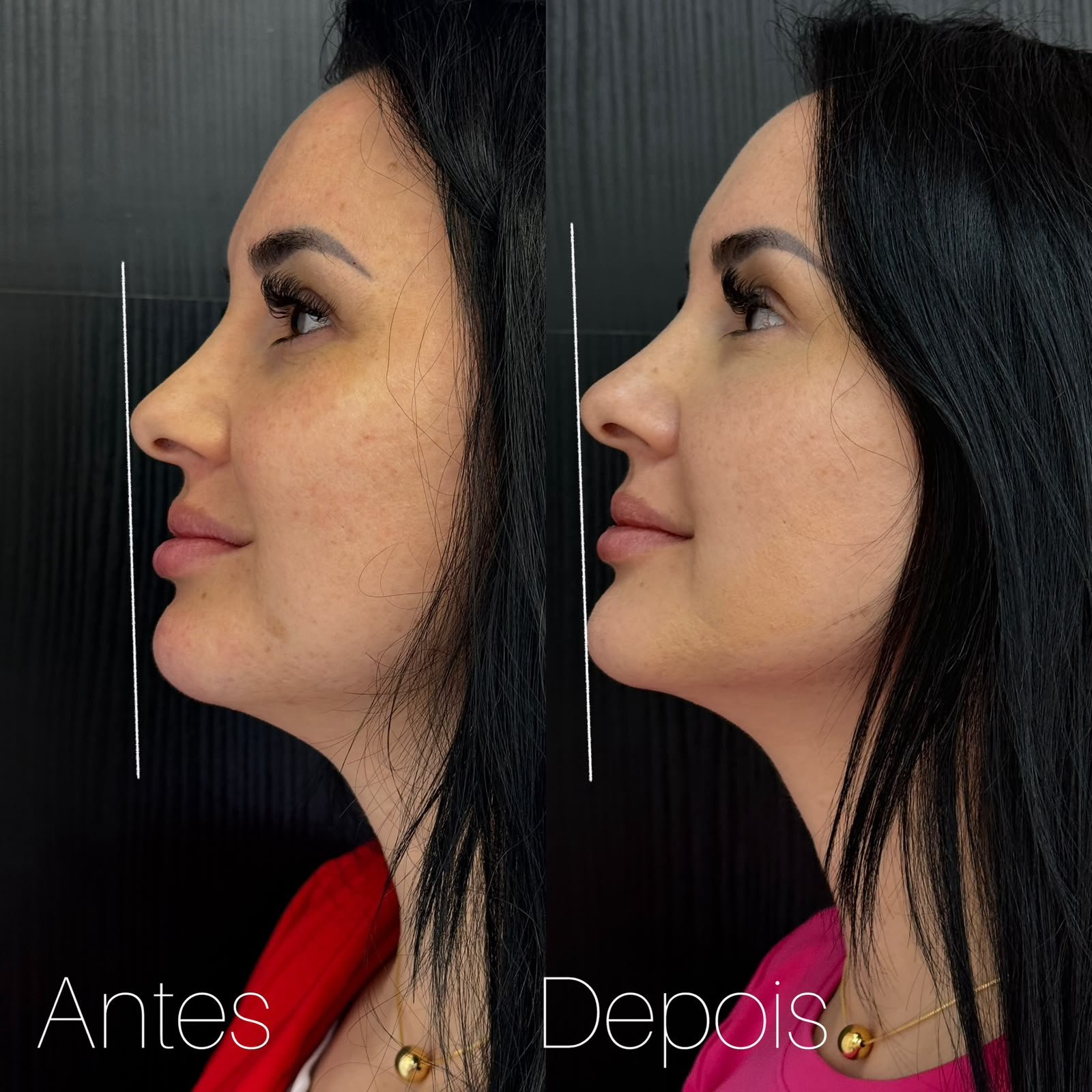 Antes e depois de tratamento de contorno facial, com linha da mandíbula mais definida