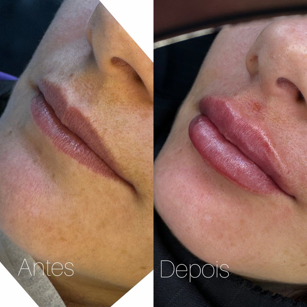Antes e depois de preenchimento labial, com contorno e volume mais definidos