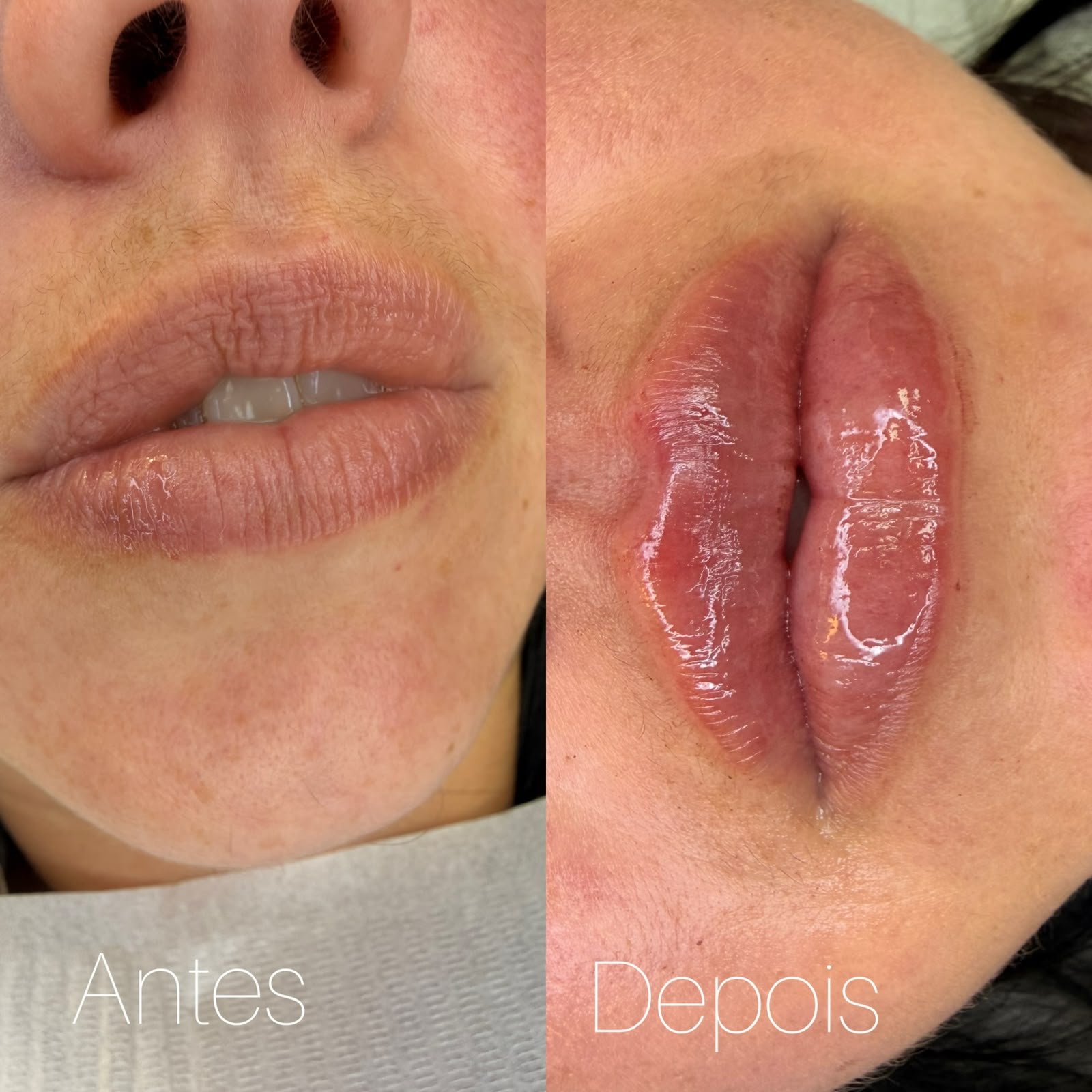 Antes e depois de preenchimento labial, com lábios mais definidos e hidratados